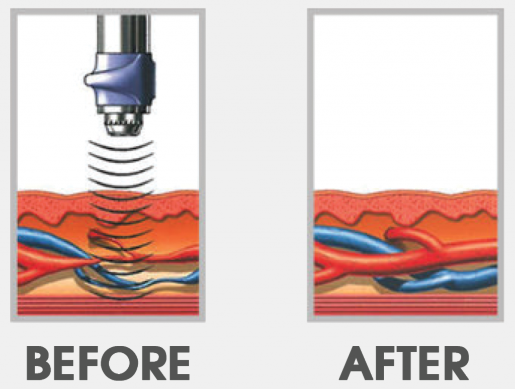 GAINSWave ED Treatment Connecticut