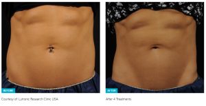 accufit results