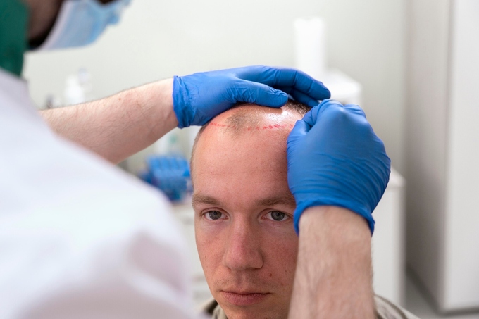 PRP Injections for Hair Loss