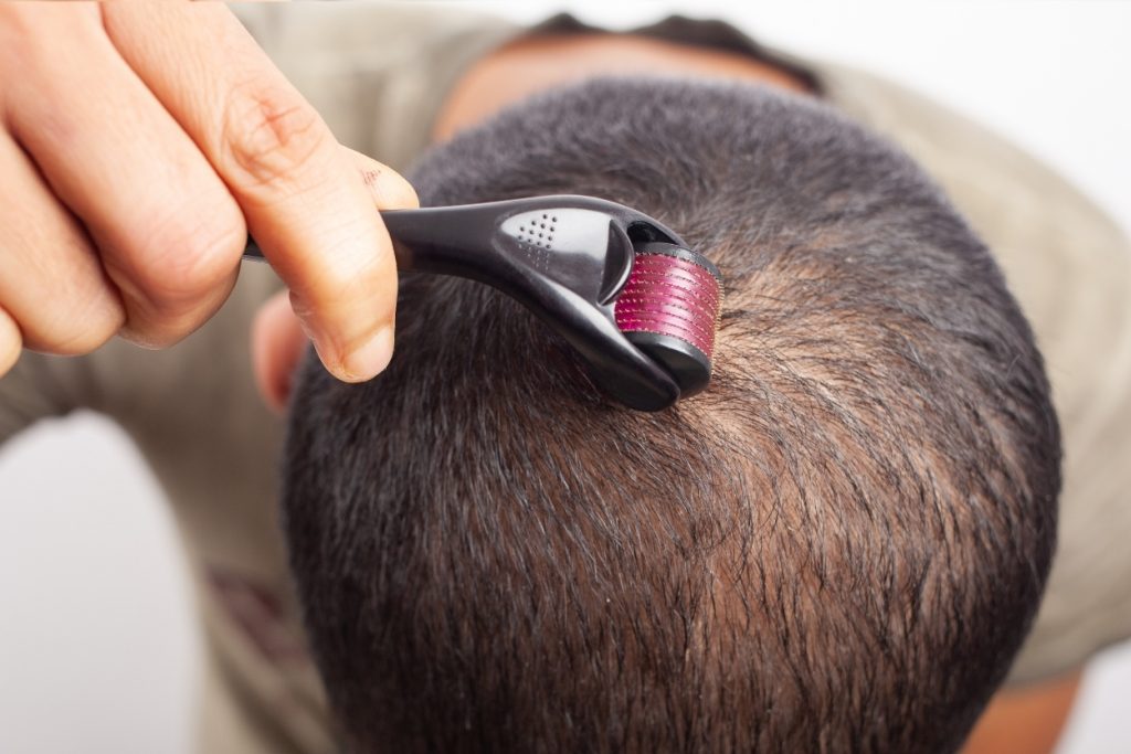 Microneedling