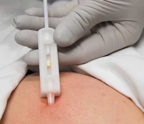 5 Reasons to Consider Bioidentical Hormone Pellets Therapy