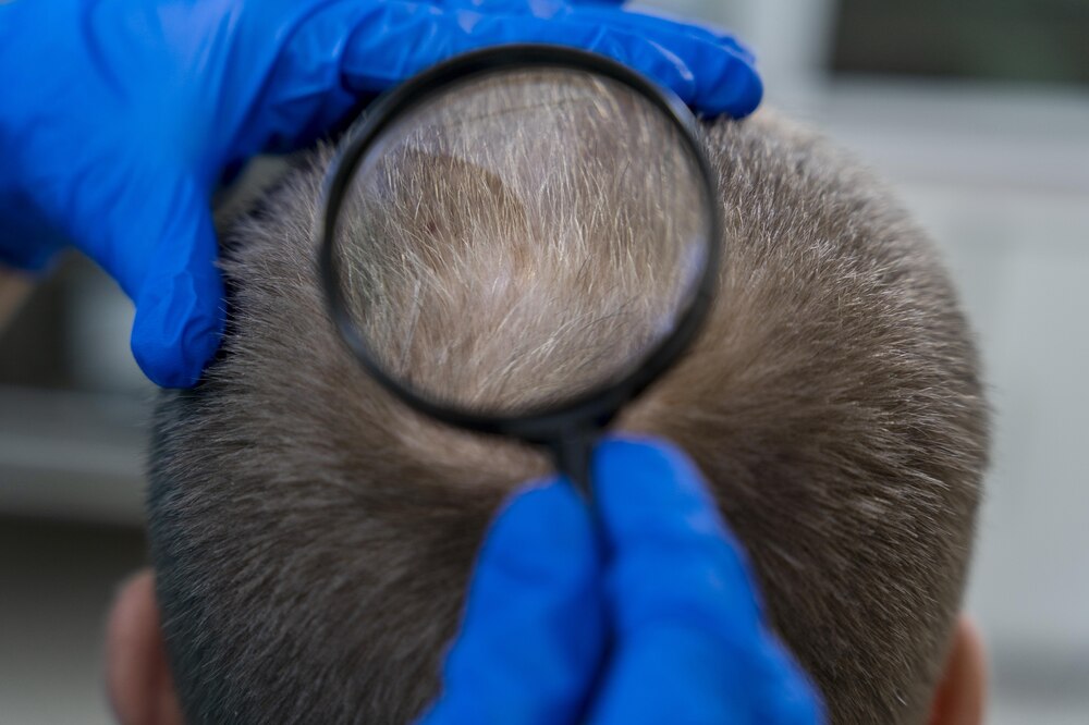 Genetics Affect Hair Loss