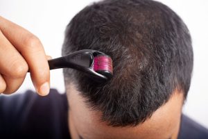 Microneedling scalp